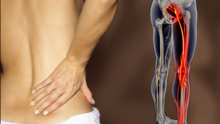 Sciatica – What is it and how do we treat it?